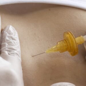 sesion-tratamiento-carboxiterapia