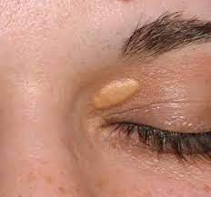 sesion-tratamiento-de-xantelasmas--siringomas