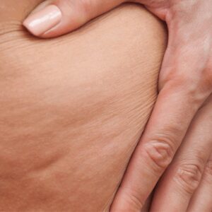 sesion-tratamiento-reduccion-celulitis-con-alidya