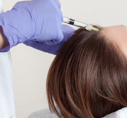 sesion-mesoterapia-capilar-con-factores-de-crecimiento