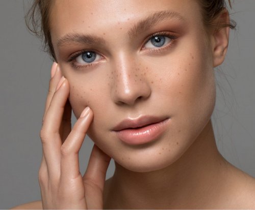 sesion-peeling-acido-acelaico