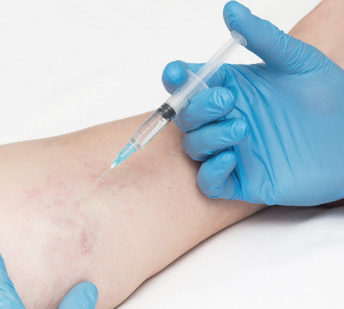 sesion-tratamiento-esclerosis-de-varices