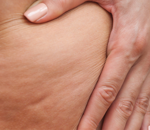 sesion-tratamiento-reduccion-celulitis-con-alidya