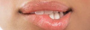 ¿Duele el relleno de labios? ¿Cómo es la recuperación?