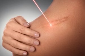 Sesion cicatrices hipertróficas y queloides