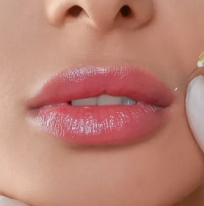 sesion-tratamiento-aumento-de-labios-acido-hialuronico