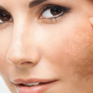 peeling-despigmentante