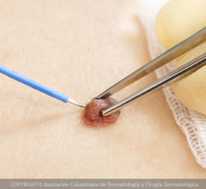 BIOPSIA GRUPO 2 COMPLICADA 506