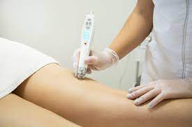 sesion-dermapen-corporal