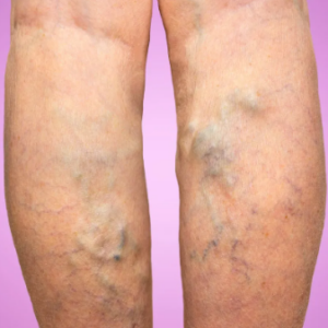test-thromboincode-hematologia-thrombo
