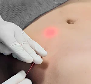 endolift-abdomen