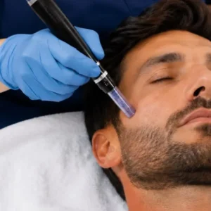 microneedling