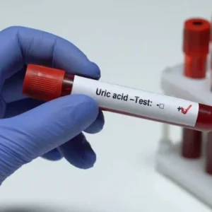 au-acido-urico-suero